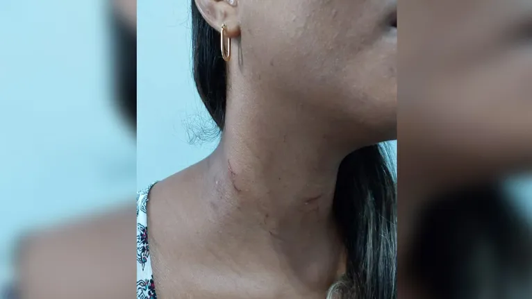 Marcas indicaram agressão sofrida
