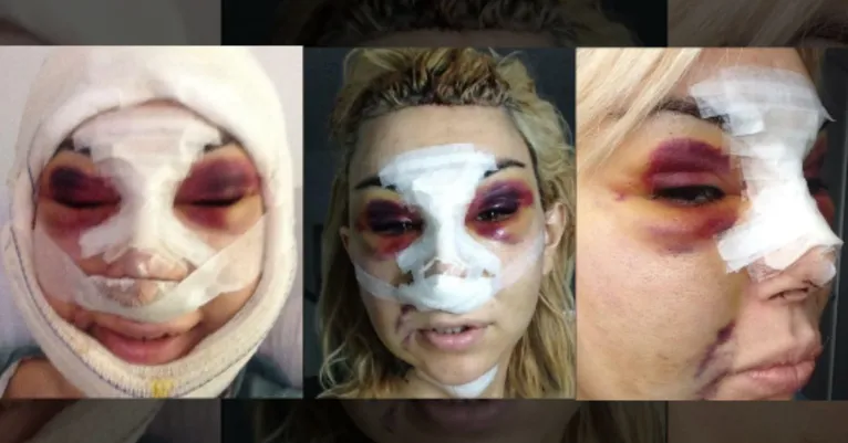 Fotos expõem as marcas deixadas pelo procedimento com substância considerada altamente perigosa.