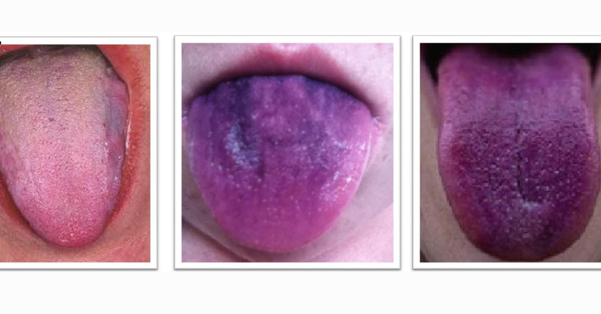 Coloração violeta ou azulada