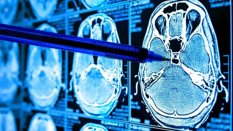 Achado reacende discussões sobre dieta, cérebro e envelhecimento saudável