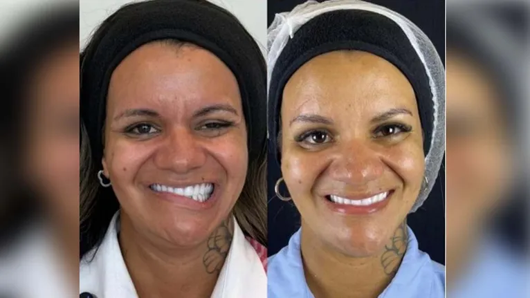 Evolução facial após procedimento de Juliana Soares