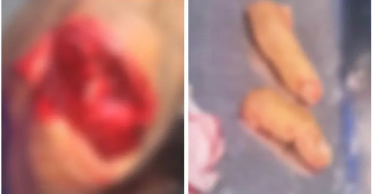 Parte do corpo atingida e os dois dedos da vítima decepados