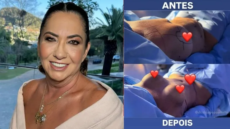 Mãe de Virginia posa de biquíni após cirurgia plástica