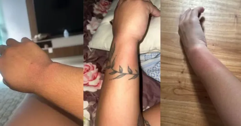 As marcas são perceptíveis nos braços dos fãs