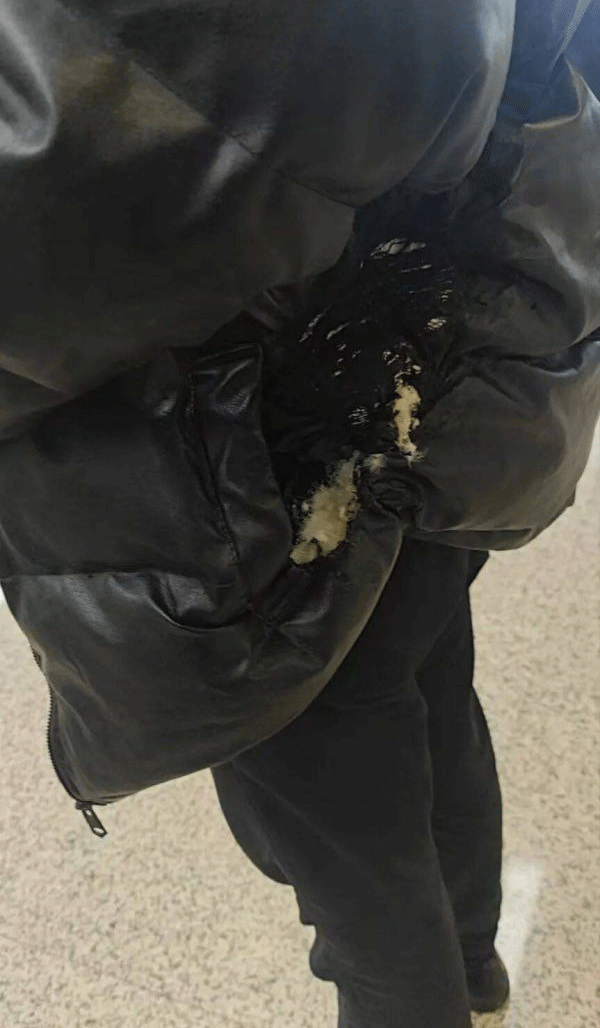 Detalhe do casaco após power bank pegar fogo.