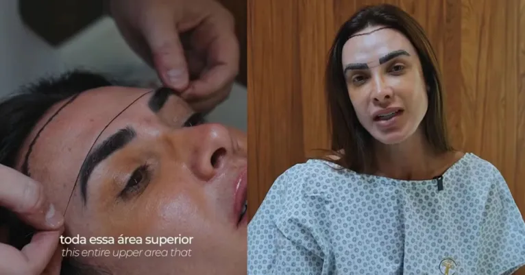 Nicole Bahls passa por transplante capilar após alopecia