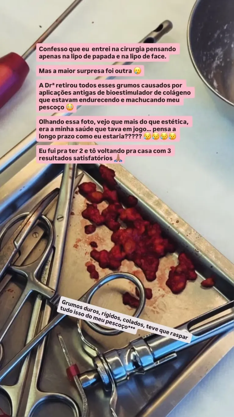 Ex-BBB Paula Freitas descobre "nódulos" no pescoço durante lipo