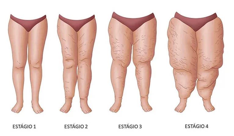 Lipedema: conheça os sintomas e tratamento da doença que afeta as mulheres