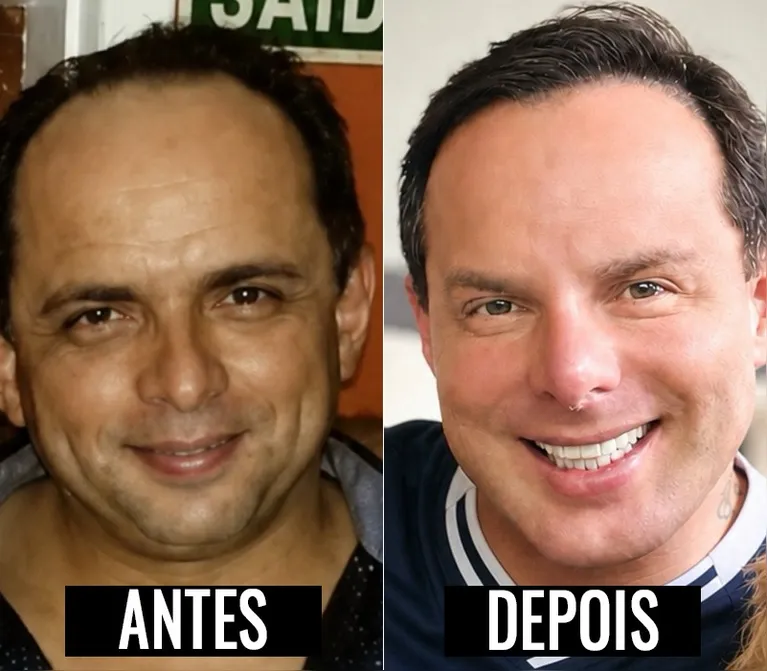 Marido de Gretchen mostra antes e depois das plásticas; confira!