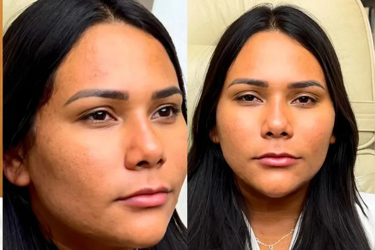 Chaiany faz harmonização facial após o BBB. Veja o resultado!