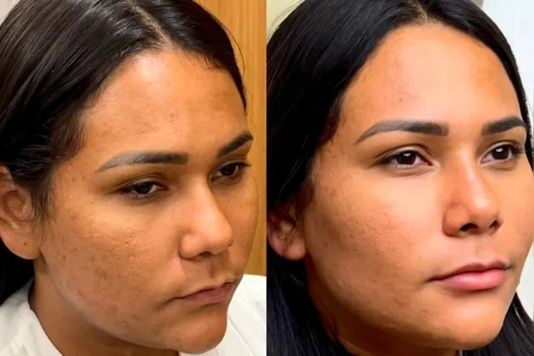 Chaiany faz harmonização facial após o BBB. Veja o resultado!