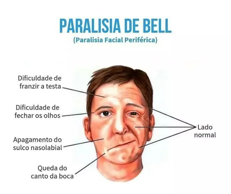 Entenda o que é a paralisia de Bell, condição que afetou cantor Nilo