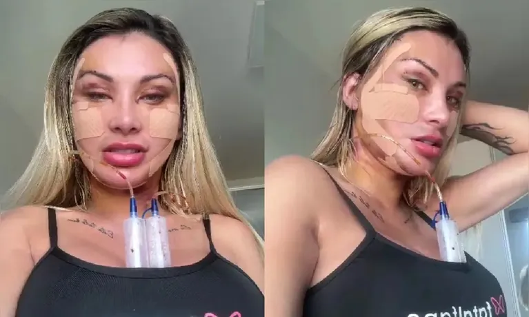 Andressa Urach mostra novo rosto após 50ª cirurgia plástica