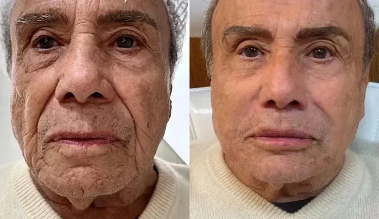 Vini Jr. não é o único: famosos que aderiram à harmonização facial
