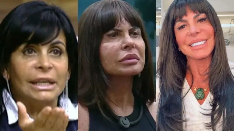Vini Jr. não é o único: famosos que aderiram à harmonização facial