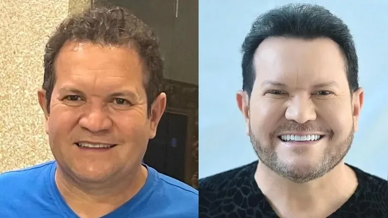 Vini Jr. não é o único: famosos que aderiram à harmonização facial