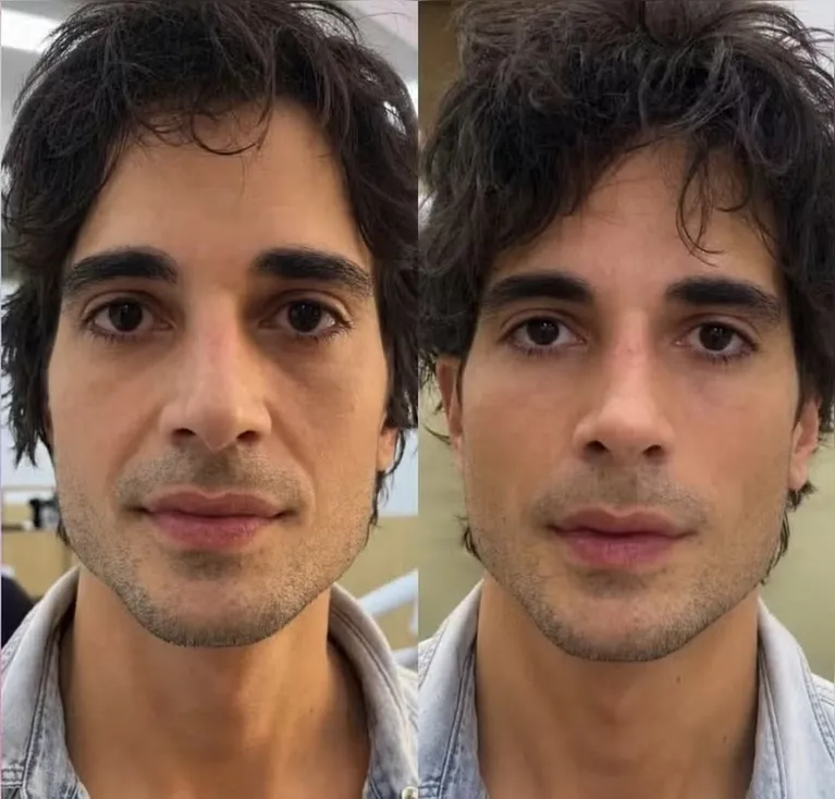Fiuk surpreende com novo visual após harmonização facial; confira!