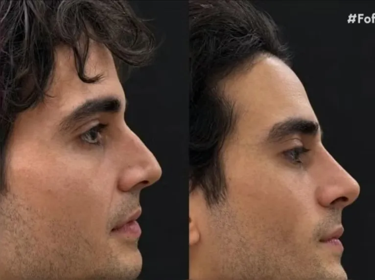Fiuk surpreende com novo visual após harmonização facial; confira!