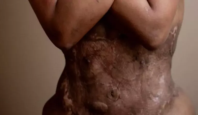 Letícia Mello teve lesões permanentes após cirurgia plástica.