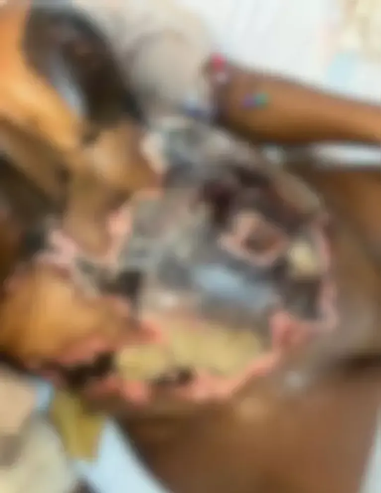 Letícia Mello teve lesões permanentes após cirurgia plástica.