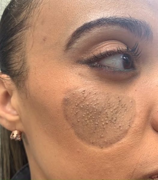 Pelos pubianos crescem no rosto de mulher após enxerto Pelos pubianos crescem no rosto de mulher após enxerto