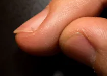 Um simples toque de protetor labial pode reduzir seriamente o tempo de cicatrização de pequenas abrasões e lesões nas unhas e dedos.