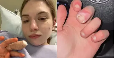 Imagem ilustrativa da notícia Hábito de roer unhas quase leva jovem à amputação de dedo