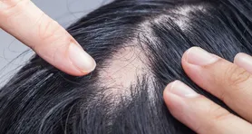 Imagem ilustrativa da notícia Alopecia areata: o que causa e como tratar as falhas no cabelo