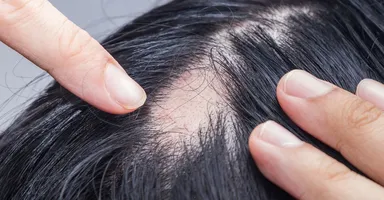 Imagem ilustrativa da notícia Alopecia areata: o que causa e como tratar as falhas no cabelo
