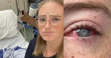Imagem ilustrativa da notícia Jovem perde a visão após tomar banho usando lentes de contato